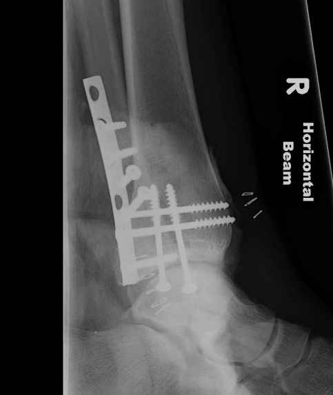 Ankle Fracture Trimalleolar ORIF Lateral
